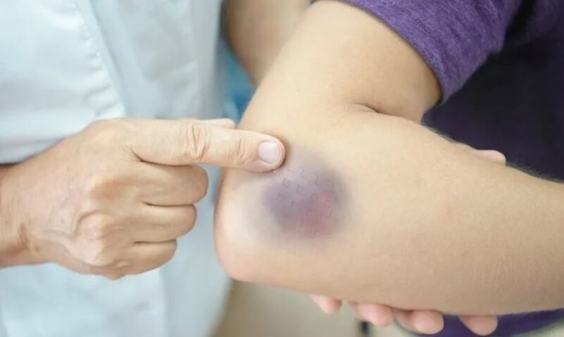 Salud | Hemofilia, una enfermedad poco frecuente que afecta a algunos varones misioneros hemofilia1 1 1 - 7