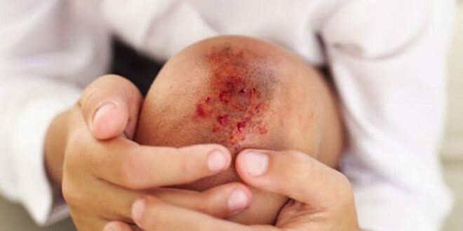 Salud | Día mundial de la hemofilia, la importancia de avanzar hacia un acceso equitativo a los diversos tratamientos 7 heridas - 6