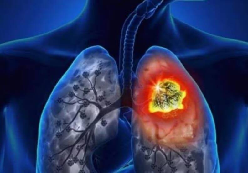 cancer pulmonar argentina - 5