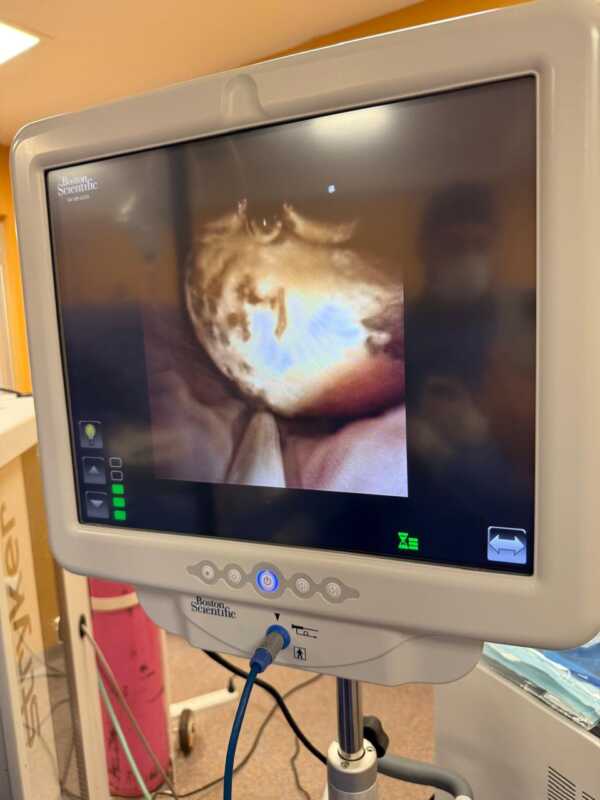 Avance en salud infantil: cirugía urológica mínimamente invasiva en el Hospital de Pediatría de Misiones 2 Durante la intervención, se utilizó el nuevo Intensificador de Imágenes recientemente incorporado al hospital Pediátrico, lo que permitió realizar la cirugía con mayor precisión y seguridad, gracias al control por radioscopía intraoperatoria.