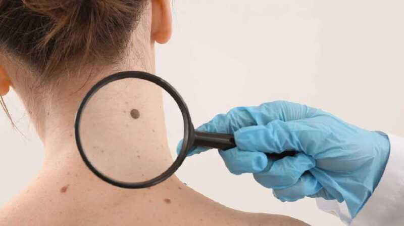 Cáncer de piel: insisten en la prevención y detección temprana 3 cancer de piel - 2