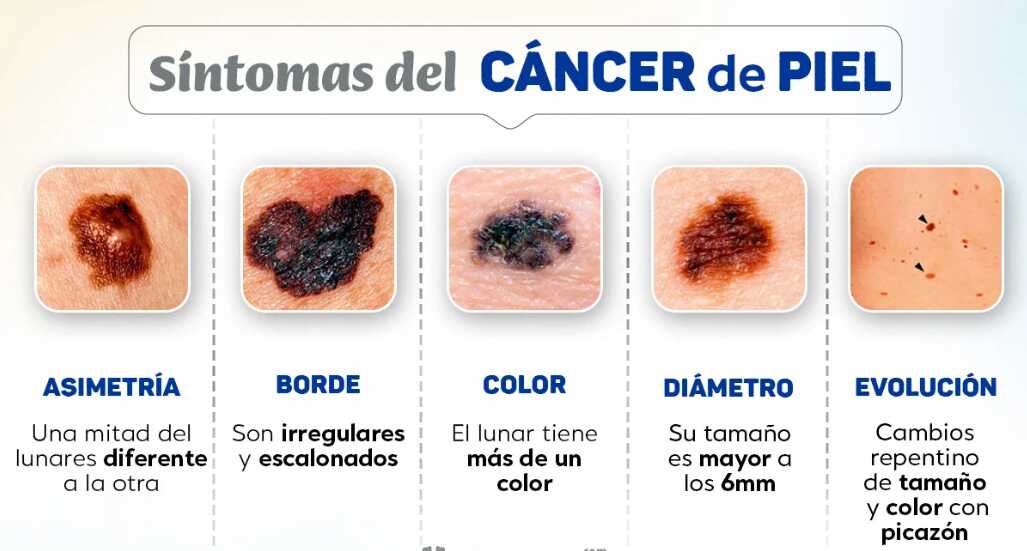 Cáncer de piel: insisten en la prevención y detección temprana 5 cancer de piel3 - 4