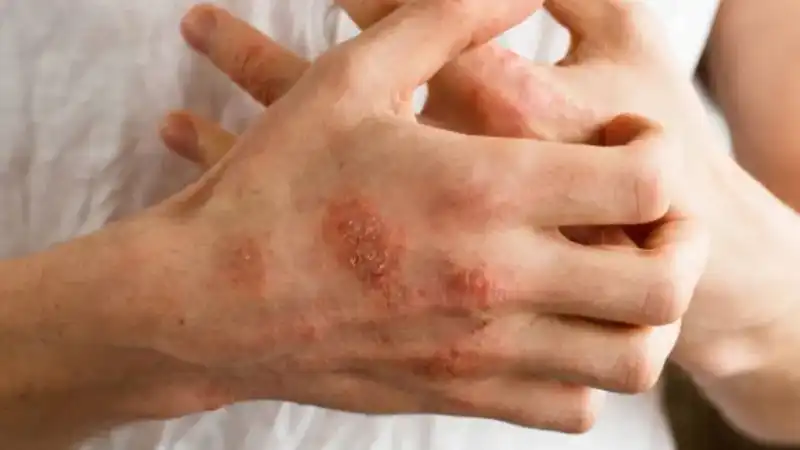Silvia Fernández Barrio: “La dermatitis atópica puede arruinar la vida si no se trata bien” 3 “No es solo una campaña de detección, también buscamos saber cómo están quienes ya tienen diagnóstico, si bajaron los brazos o si están desarrollando nuevas alergias”, explicó Silvia Fernández Barrio