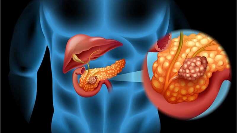 Misiones impulsa una ley para el abordaje integral del cáncer de páncreas 3 WhatsApp Image 2025 07 10 at 12.14.54 - 2