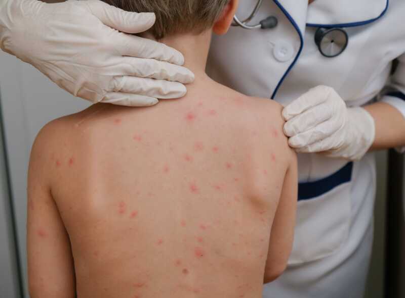 Golpes de calor y gastroenteritis: las amenazas del verano para los más chicos 5 Sarampión