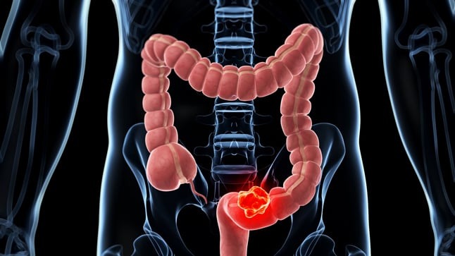 Advierten sobre la importancia de detectar a tiempo el cáncer de colon: “No hace falta tener síntomas” cáncer de colon