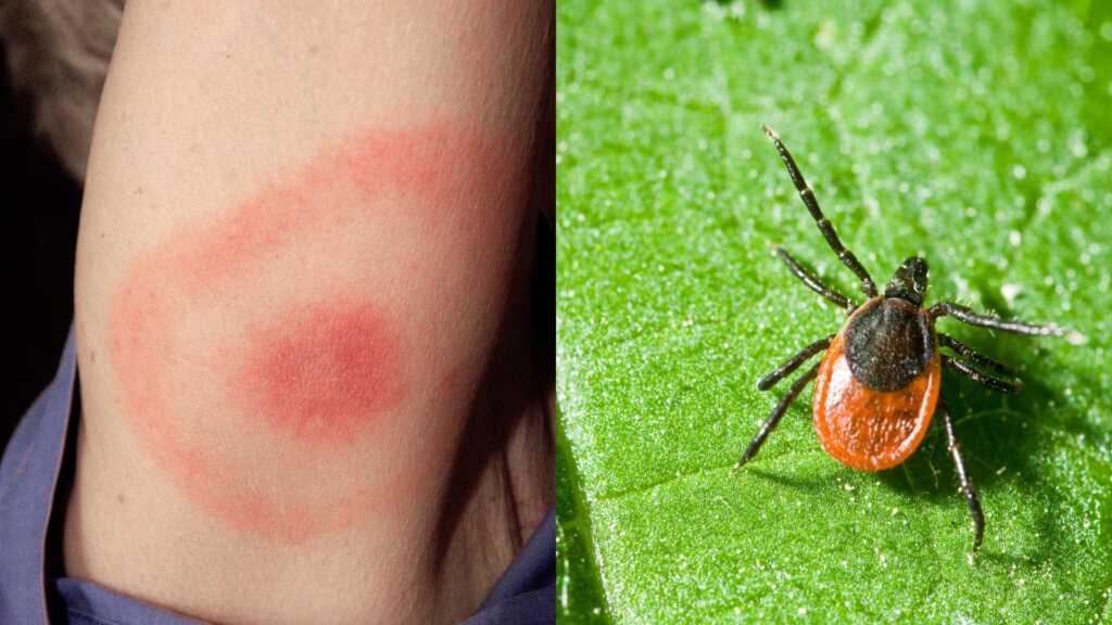 enfermedad de lyme - 2