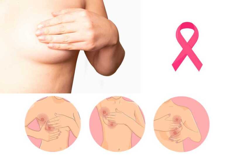 Cáncer de mama en Argentina: la importancia de la prevención y el diagnóstico temprano 2 Cáncer