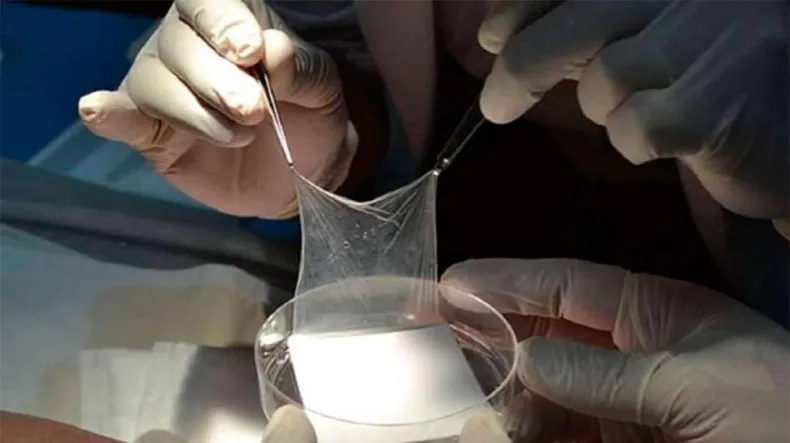 Misiones desarrolla parches biológicos con placenta para tratar quemaduras y heridas complejas placenta