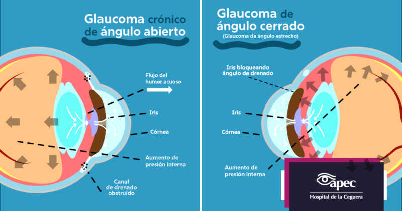 Glaucoma: la enfermedad silenciosa que ya afecta a más de un millón de argentinos 3 Glaucoma