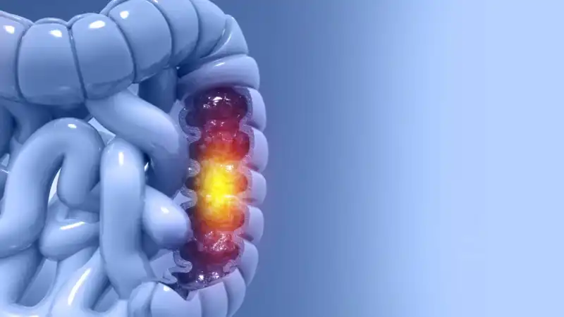 Cáncer de colon en Argentina: baja tasa de testeo y la detección temprana como herramienta clave para reducir la mortalidad 4 Especialistas advierten que aumentar los controles podría reducir significativamente la mortalidad por cáncer de colon.