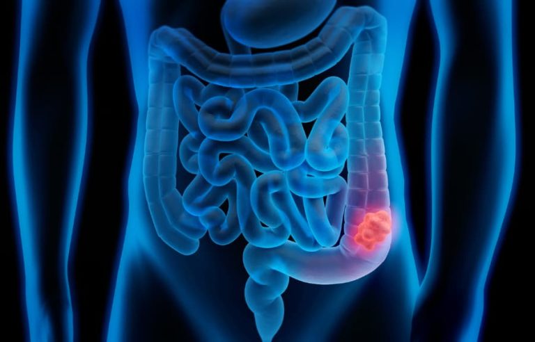 Cáncer de colon en Argentina: baja tasa de testeo y la detección temprana como herramienta clave para reducir la mortalidad 3 Solo 3 de cada 10 personas en riesgo se realizan estudios preventivos de cáncer colorrectal en el país.