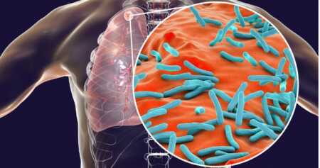 Día Mundial de la Tuberculosis: Argentina actualiza sus pautas para enfrentar una enfermedad que sigue en aumento La tuberculosis continúa siendo una de las principales enfermedades infecciosas a nivel global, con millones de casos y muertes cada año.