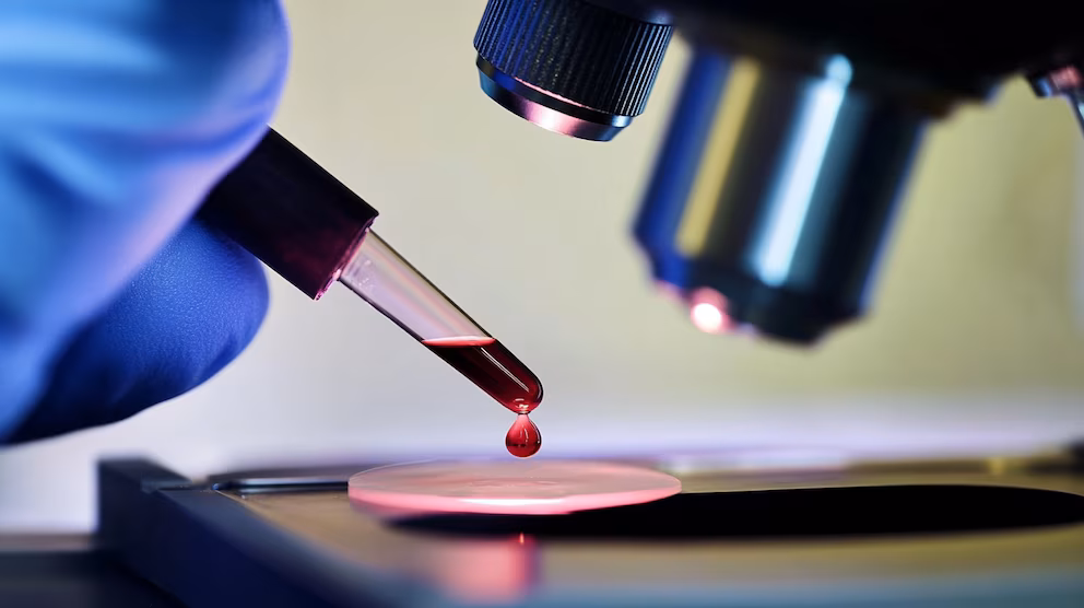Nueva era en leucemia: tratamientos más eficaces y menos agresivos