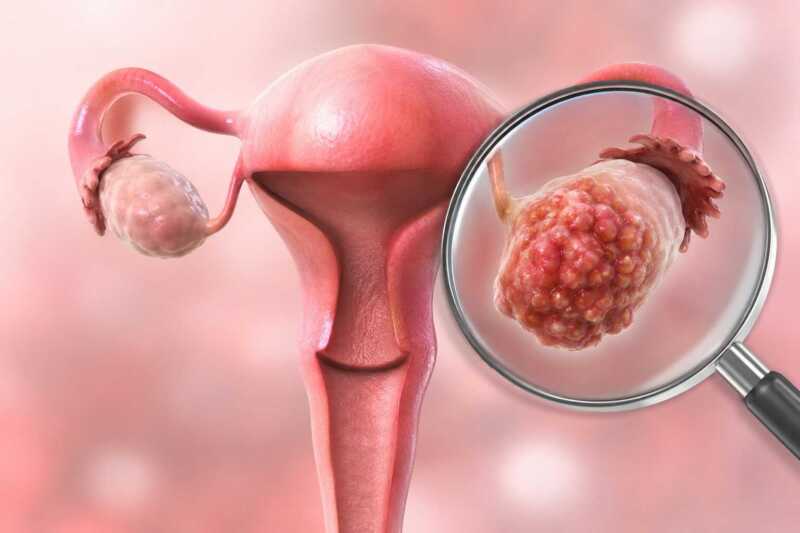 El cáncer de ovario continúa siendo uno de los tumores ginecológicos con mayor mortalidad debido a la dificultad para detectarlo en etapas tempranas.