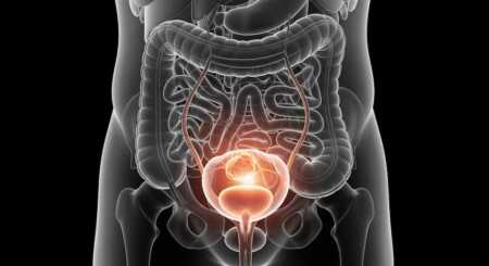 Cáncer de vejiga: cuáles son los síntomas y factores de riesgo más frecuentes cancer vej1 - 2
