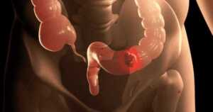 Cáncer colorrectal: crecen los diagnósticos en América Latina y refuerzan el llamado a la detección temprana Cancer colorrectal 1 1024x538 1 - 1