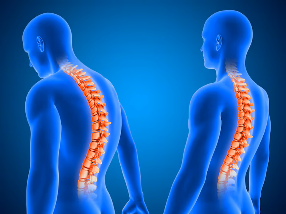 Escoliosis: especialistas advierten que afecta al 4% de los niños y destacan la importancia de la detección temprana 6 Escoliosis - 5