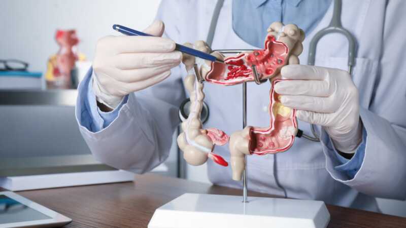 Cáncer colorrectal: crecen los diagnósticos en América Latina y refuerzan el llamado a la detección temprana 5 colon model 1200x675 1 - 4