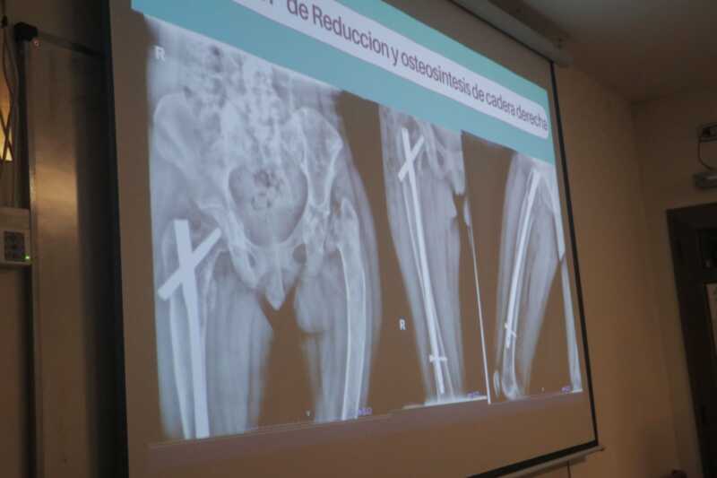 Caso único: especialistas del Madariaga trataron una rara enfermedad genética con compromiso óseo 3 Hospital Madariaga trató con éxito un caso excepcional de enfermedad genética y fractura de cadera