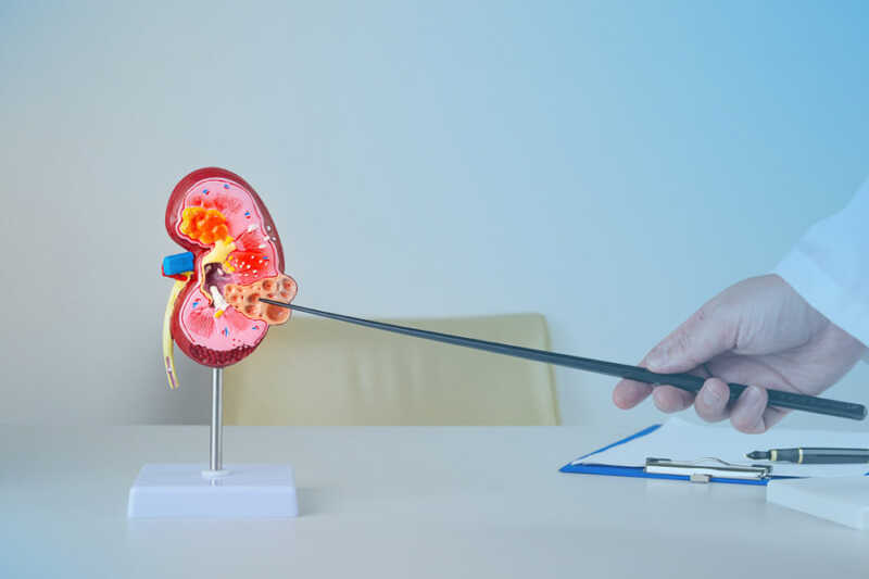 Día Mundial del Cáncer de Riñón: remarcan que la detección temprana sigue siendo un factor clave 2 Los especialistas advierten que la ausencia de manifestaciones clínicas tempranas dificulta la identificación del tumor cuando aún puede ser tratado con mayores probabilidades de éxito.
